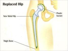 Older style hip replacement